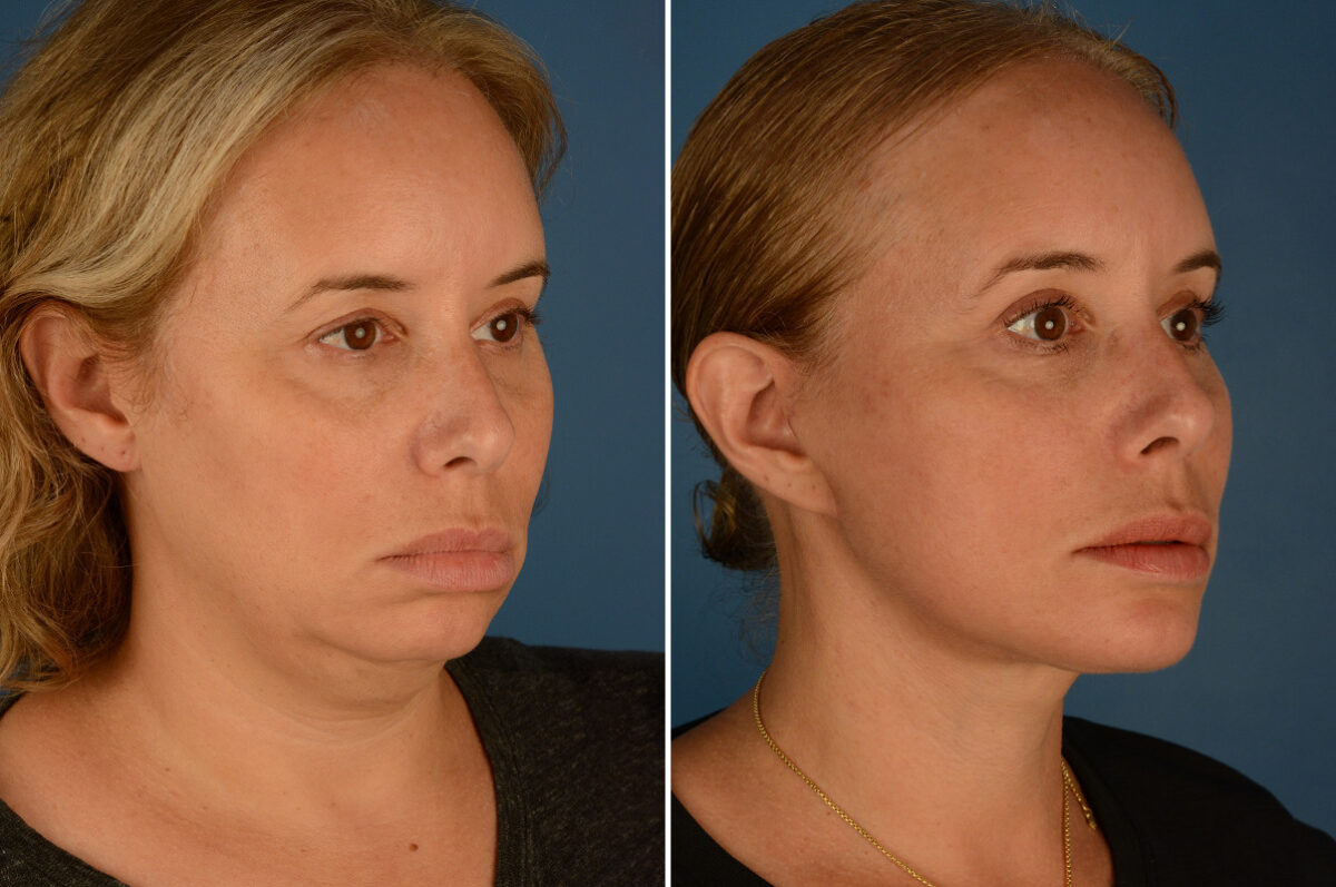 Chin and Cheek Implant Before and After Photos in Naples, FL, Patient 23517