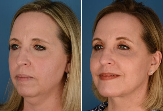 The UpLift™ Lower Face and Neck Lift Before and After Photos in Naples, FL, Patient 23546