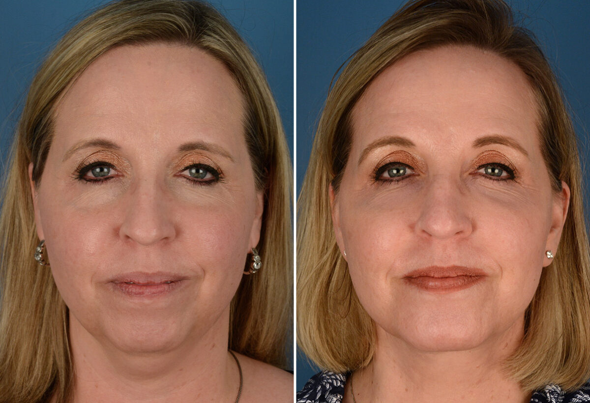 The UpLift™ Lower Face and Neck Lift Before and After Photos in Naples, FL, Patient 23546