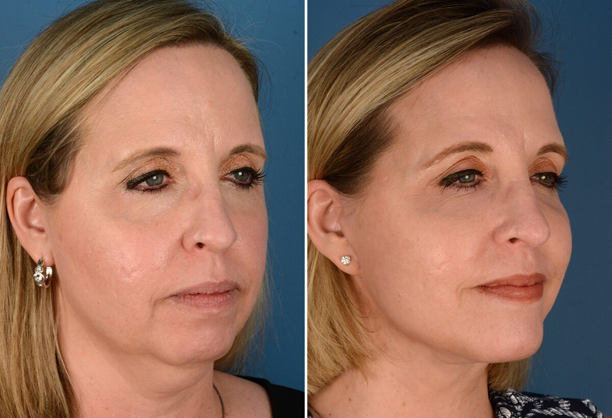 The UpLift™ Lower Face and Neck Lift Before and After Photos in Naples, FL, Patient 23546