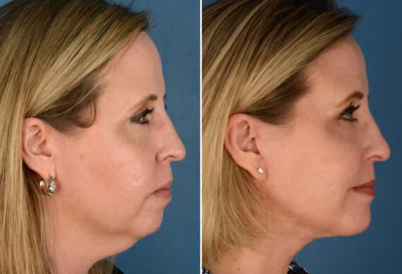 The UpLift™ Lower Face and Neck Lift Before and After Photos in Naples, FL, Patient 23546