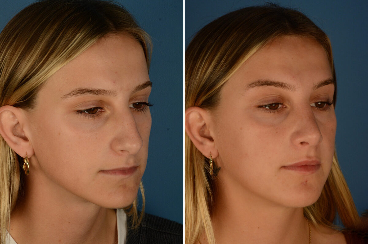 Rhinoplasty Before and After Photos in Naples, FL, Patient 23571