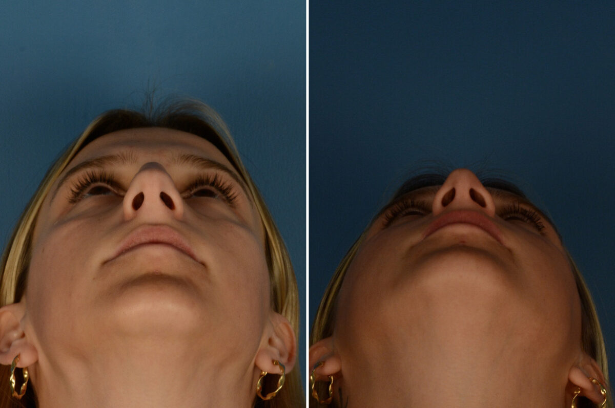 Rhinoplasty Before and After Photos in Naples, FL, Patient 23571