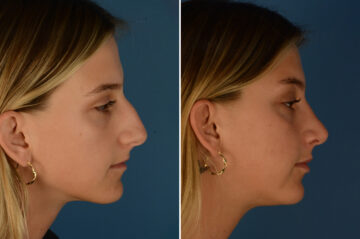 Rhinoplasty Before and After Photos in Naples, FL, Patient 23571