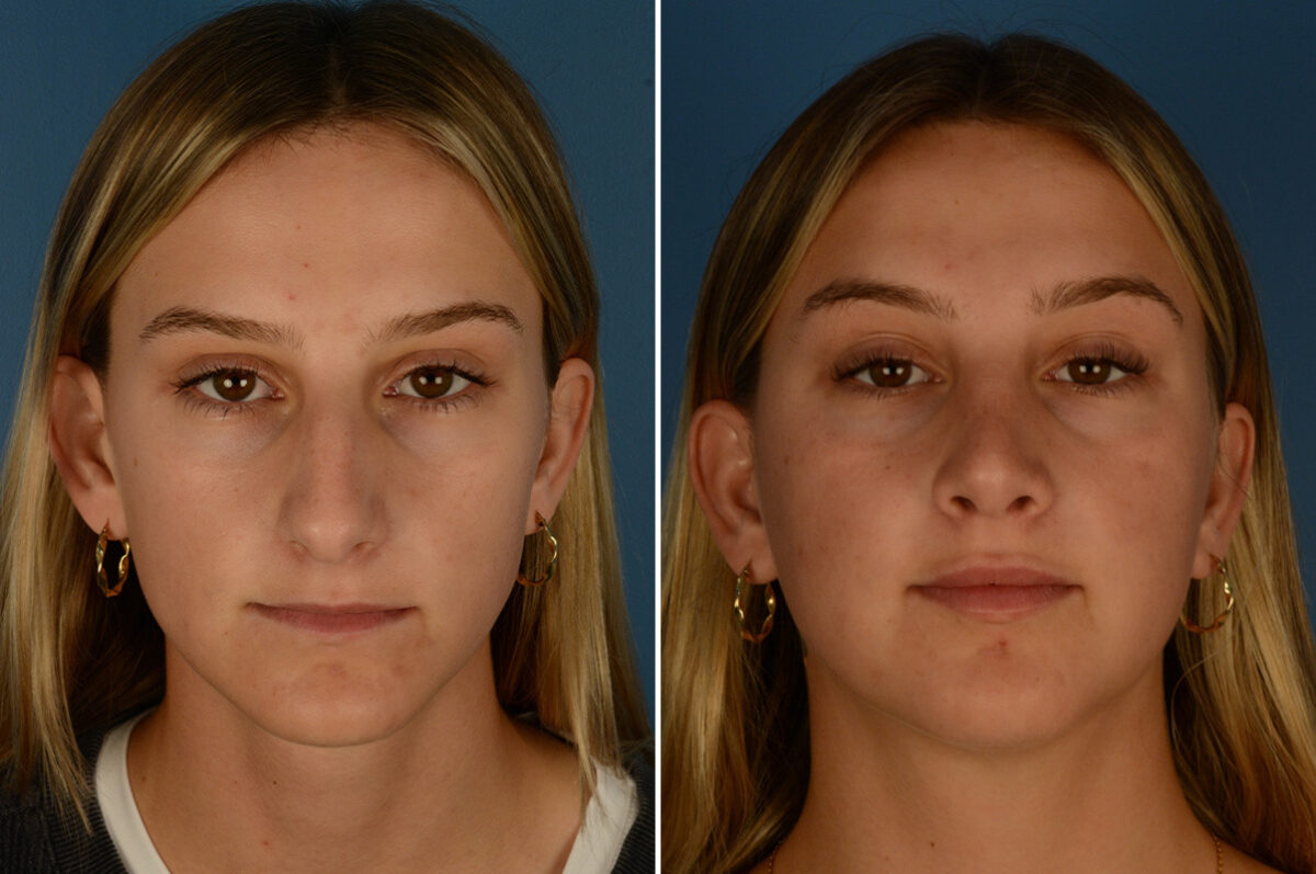 Rhinoplasty Before and After Photos in Naples, FL, Patient 23571