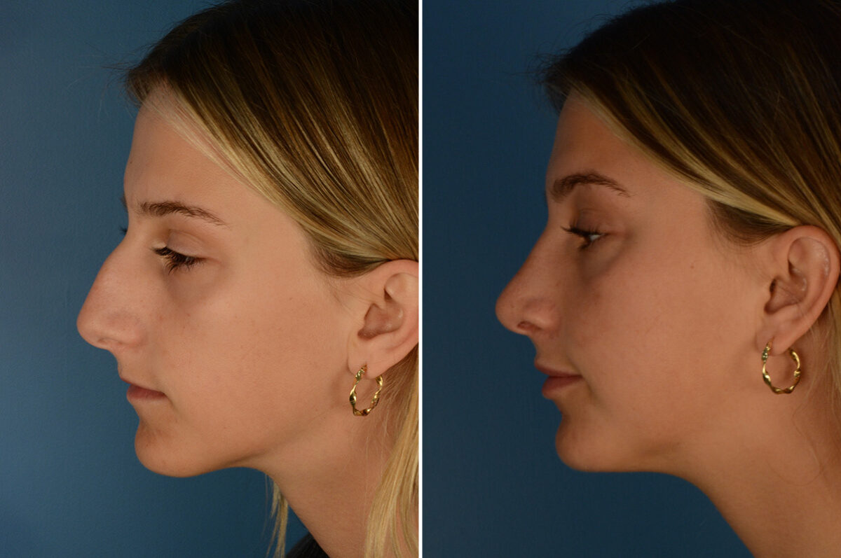 Rhinoplasty Before and After Photos in Naples, FL, Patient 23571