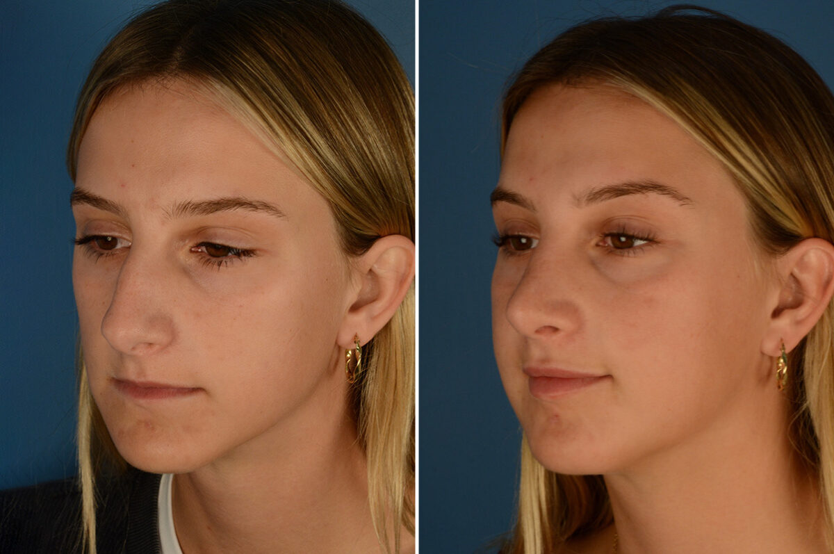 Rhinoplasty Before and After Photos in Naples, FL, Patient 23571