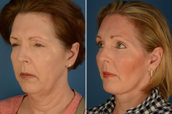 Endoscopic Facelift Before and After Photos in Naples, FL, Patient 23595