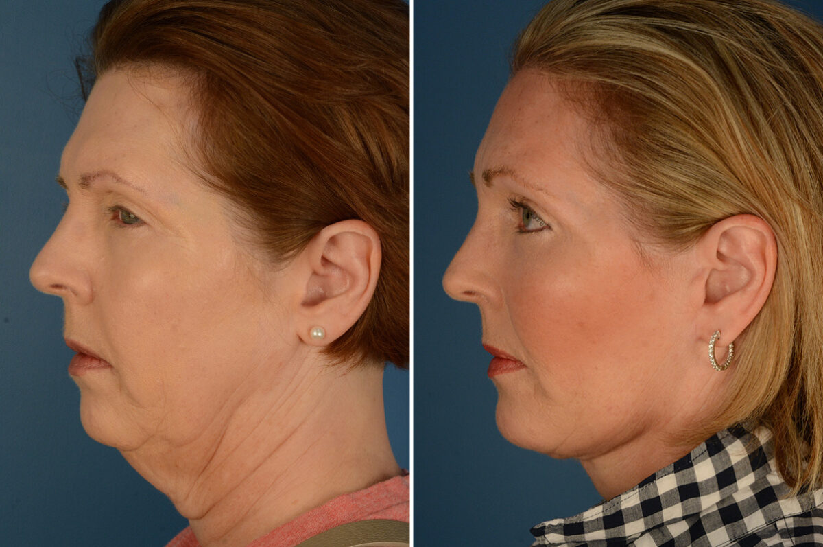Endoscopic Facelift Before and After Photos in Naples, FL, Patient 23595