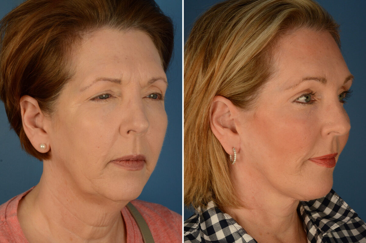 Endoscopic Facelift Before and After Photos in Naples, FL, Patient 23595