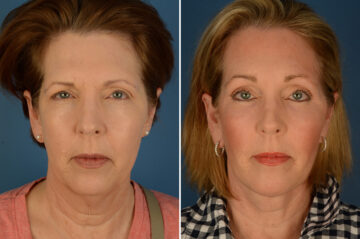 Endoscopic Facelift Before and After Photos in Naples, FL, Patient 23595