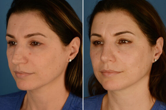 Rhinoplasty Before and After Photos in Naples, FL, Patient 23646
