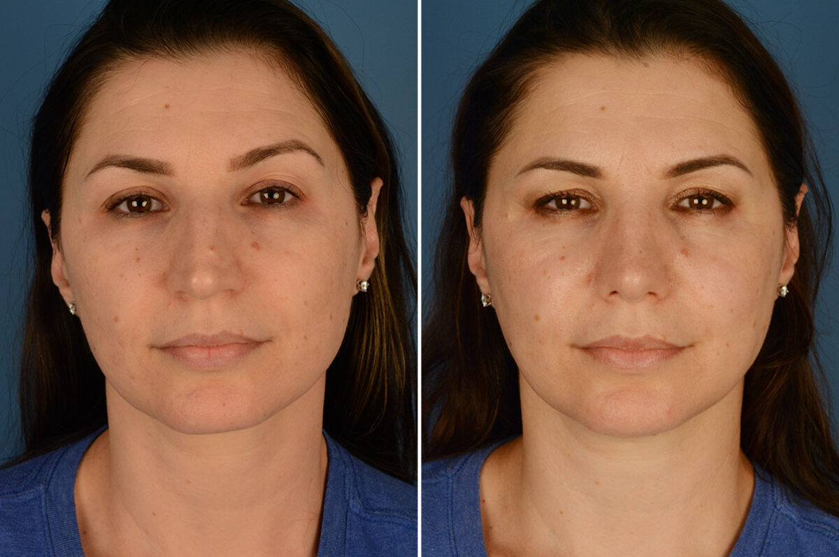 Rhinoplasty Before and After Photos in Naples, FL, Patient 23646