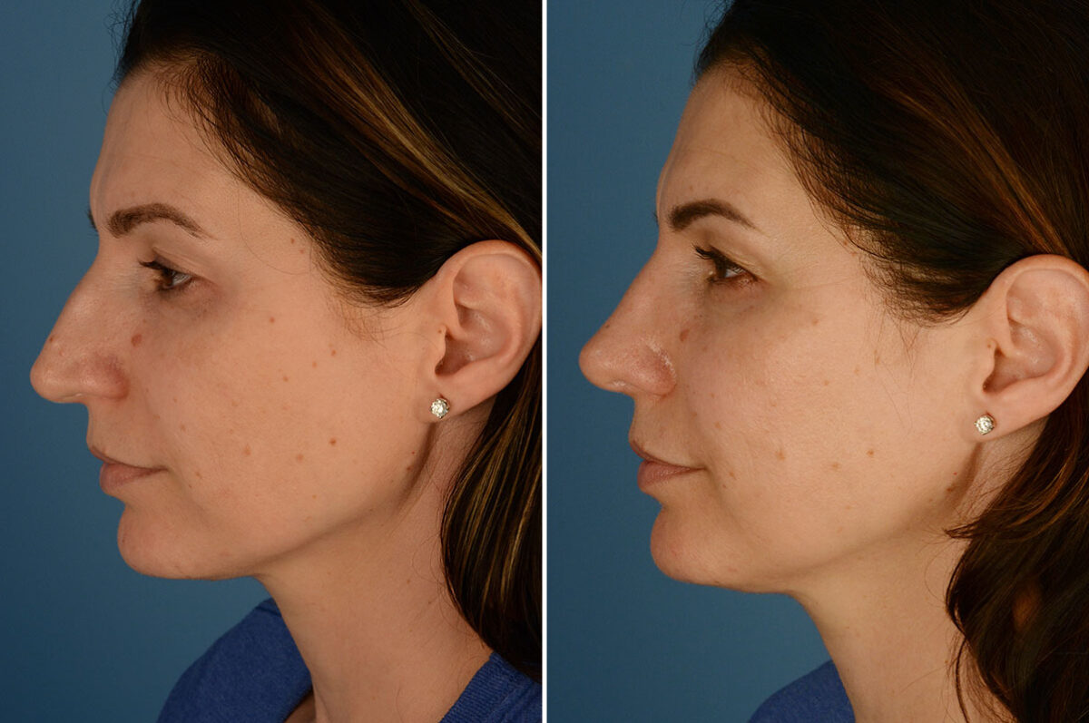 Rhinoplasty Before and After Photos in Naples, FL, Patient 23646
