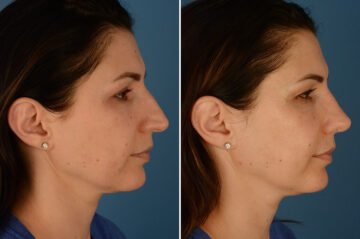 Rhinoplasty Before and After Photos in Naples, FL, Patient 23646