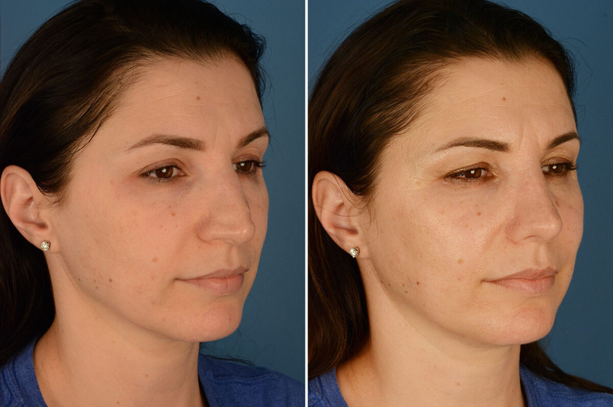Rhinoplasty Before and After Photos in Naples, FL, Patient 23646