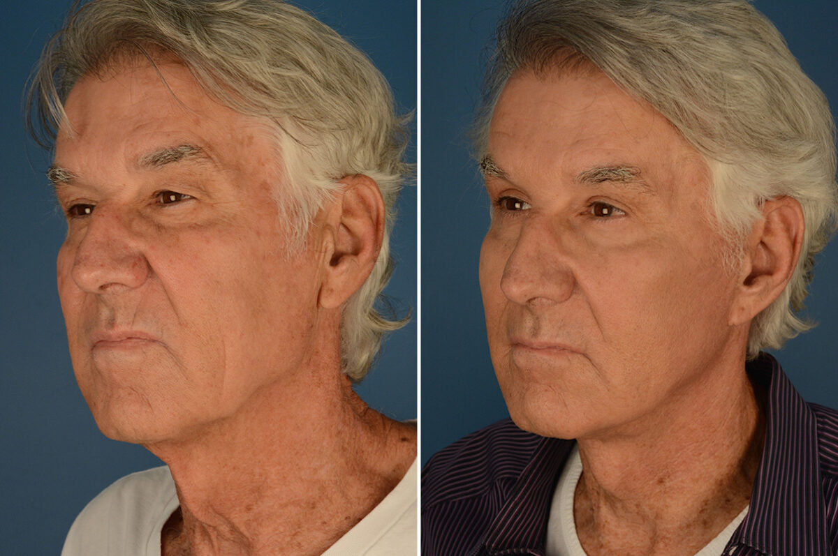 Cheek Implants Before and After Photos in Naples, FL, Patient 23663