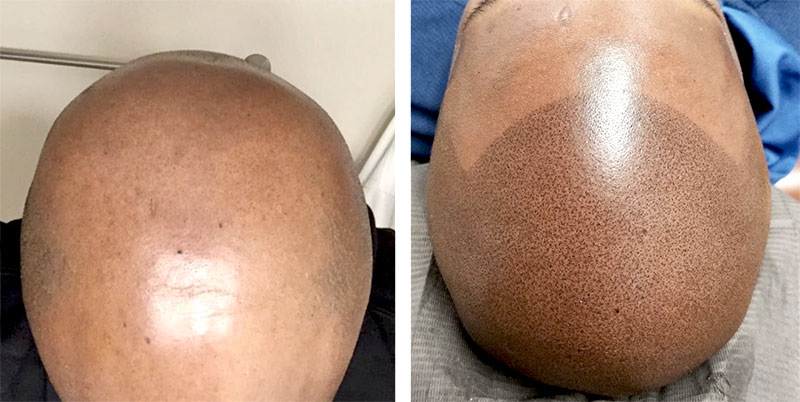 Scalp Restoration/Micropigmentation