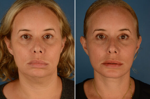 Chin Implant Before and After Photos in Naples, FL, Patient 23517