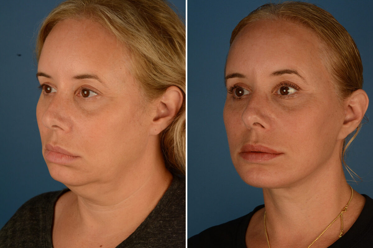 Chin Implant Before and After Photos in Naples, FL, Patient 23517