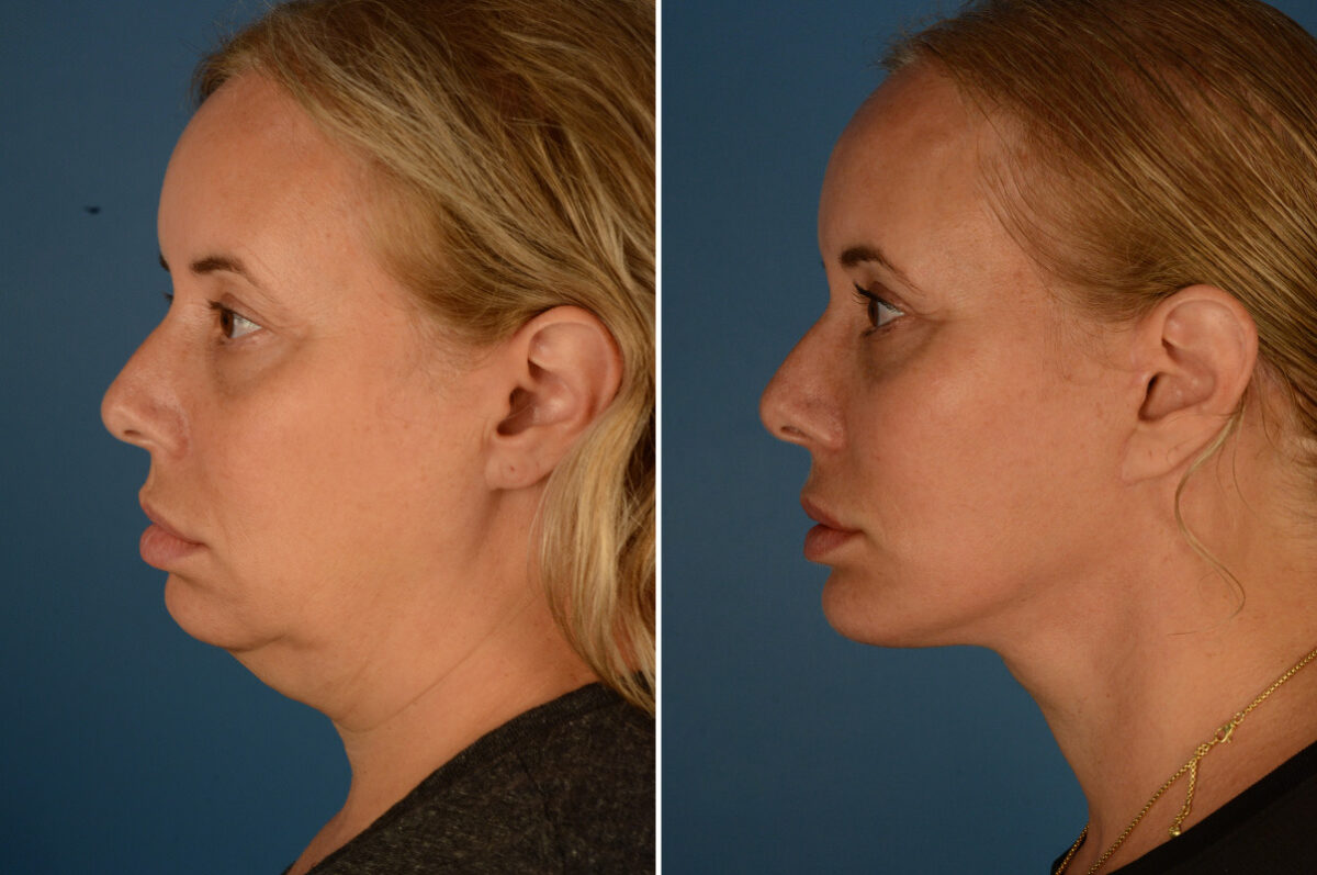 Chin Implant Before and After Photos in Naples, FL, Patient 23517