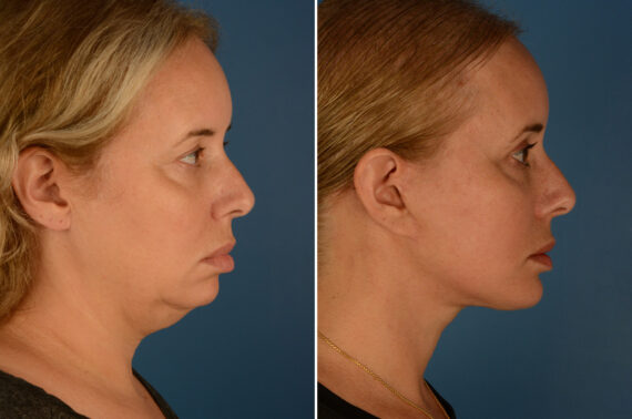 Chin Implant Before and After Photos in Naples, FL, Patient 23517