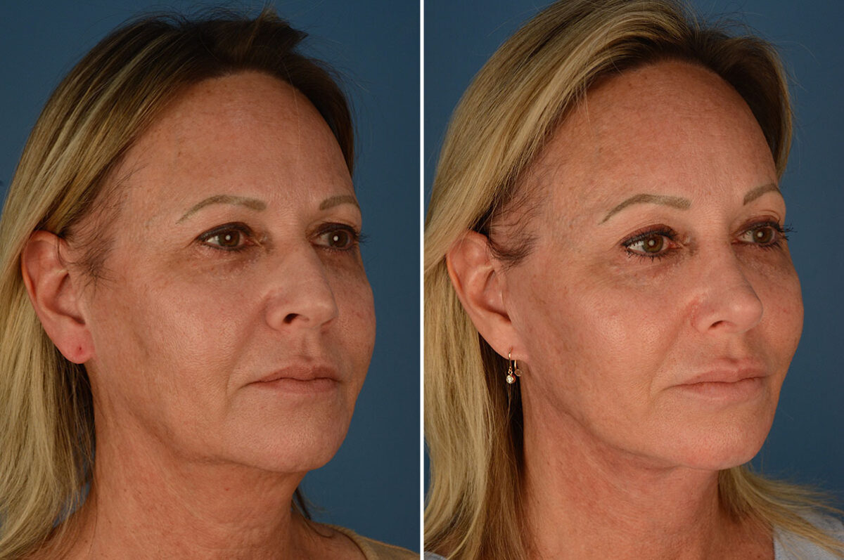 Rhinoplasty Before and After Photos in Naples, FL, Patient 23769