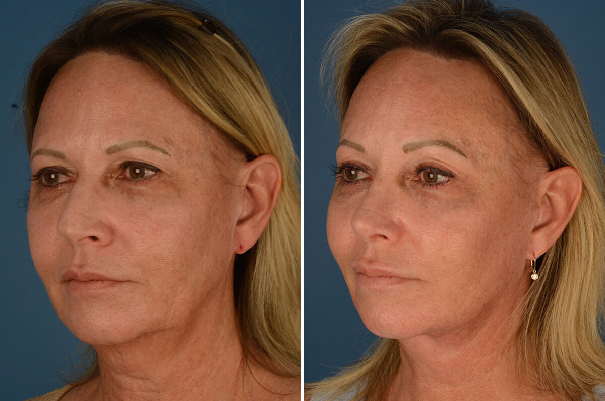 Rhinoplasty Before and After Photos in Naples, FL, Patient 23769