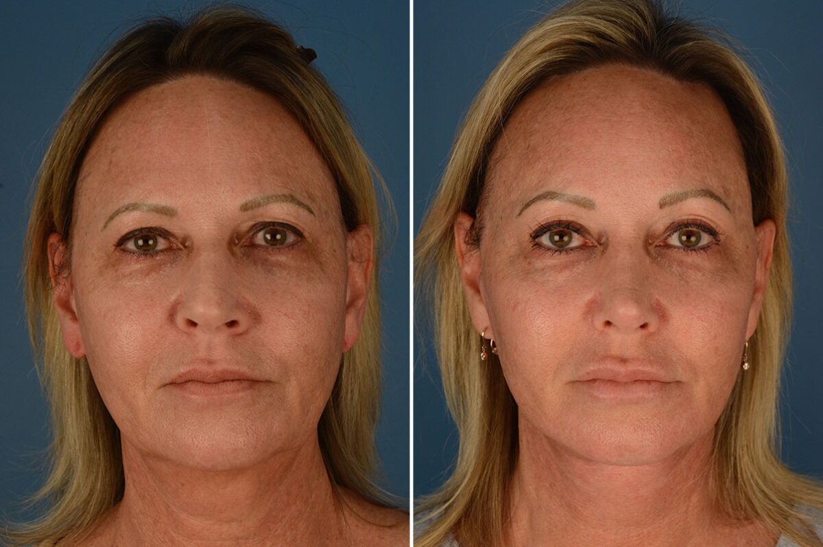 Rhinoplasty Before and After Photos in Naples, FL, Patient 23769