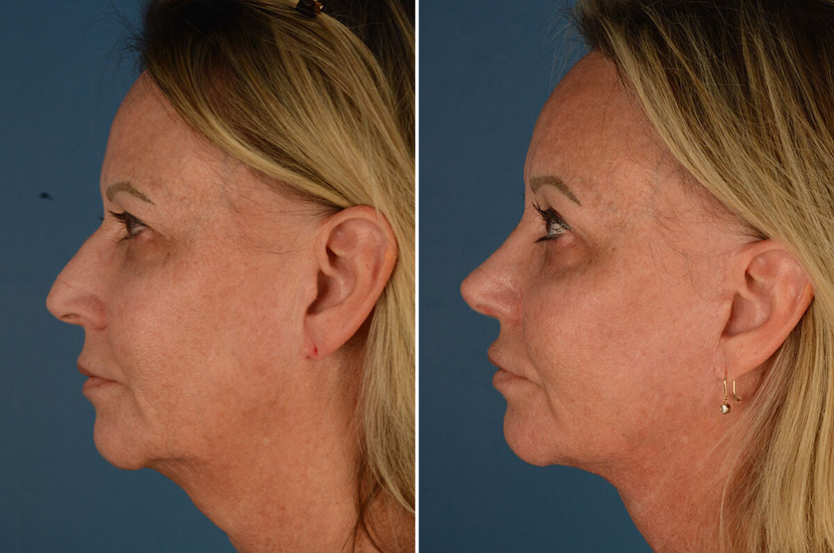 Rhinoplasty Before and After Photos in Naples, FL, Patient 23769
