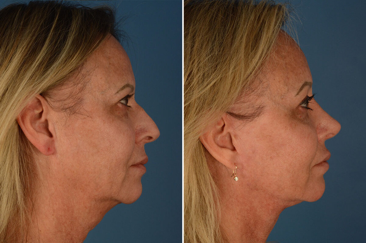Rhinoplasty Before and After Photos in Naples, FL, Patient 23769