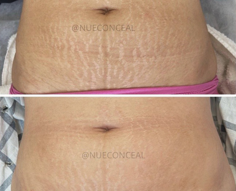 Scar treatments/camouflaging