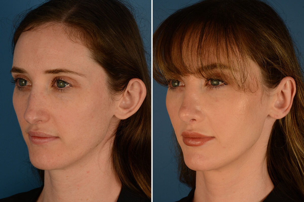 Otoplasty Before and After Photos in Naples, FL, Patient 23915