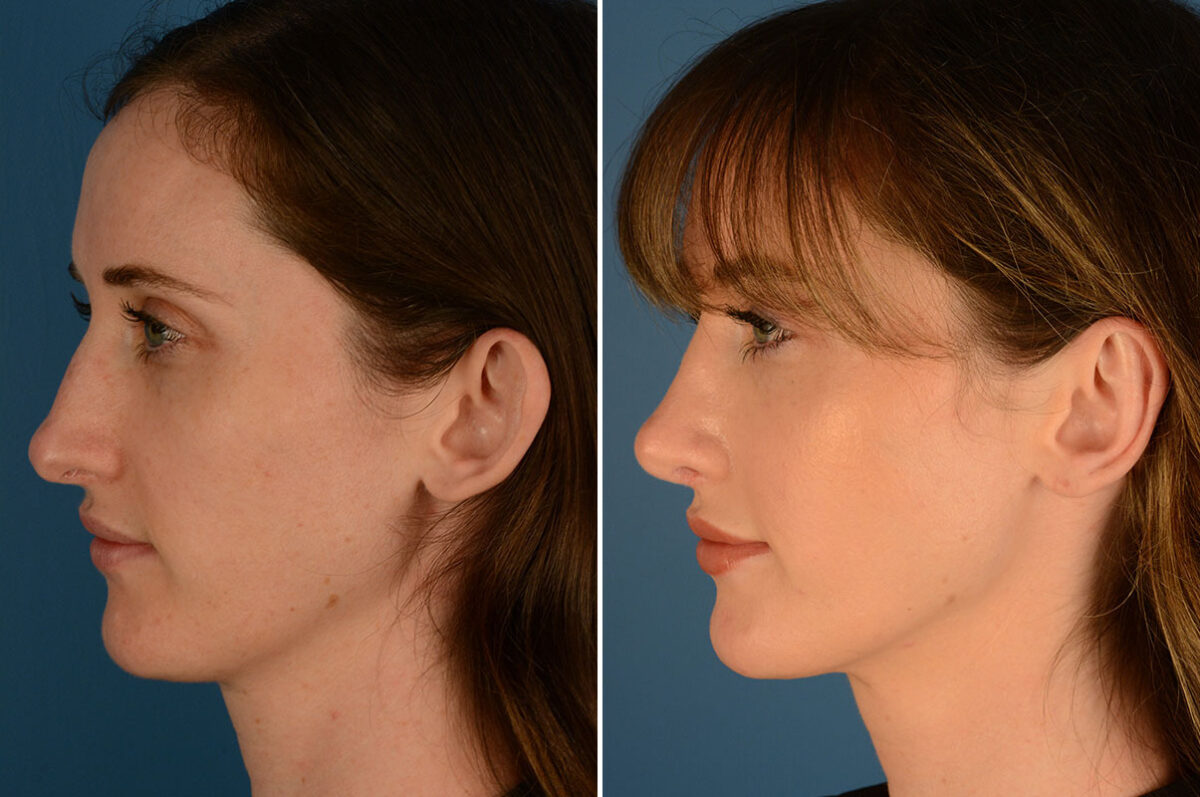 Otoplasty Before and After Photos in Naples, FL, Patient 23915