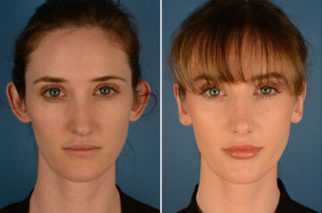 Otoplasty Before and After Photos in Naples, FL, Patient 23915