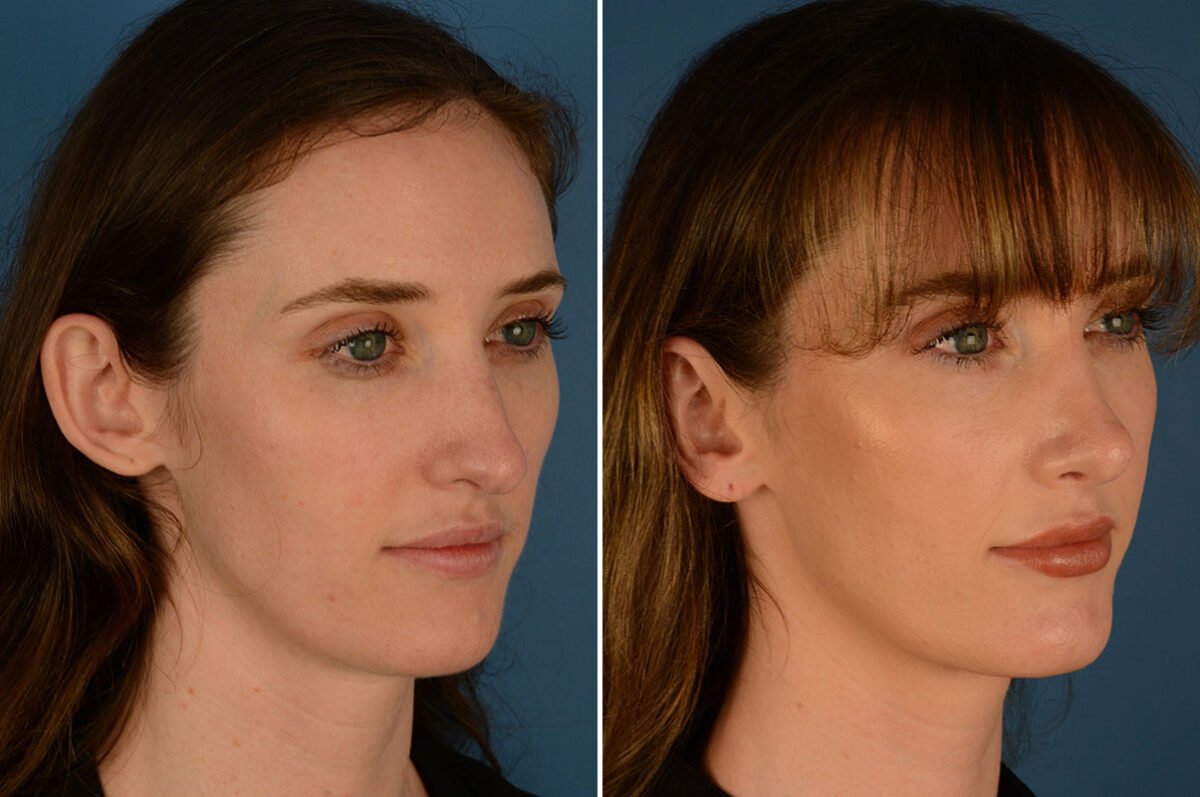 Otoplasty Before and After Photos in Naples, FL, Patient 23915