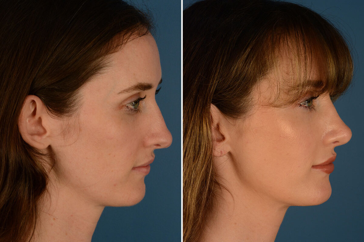 Otoplasty Before and After Photos in Naples, FL, Patient 23915