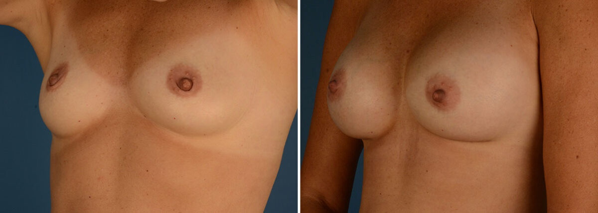 Breast Augmentation Before and After Photos in Naples, FL, Patient 23945