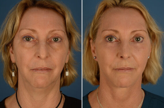 The UpLift™ Lower Face and Neck Lift Before and After Photos in Naples, FL, Patient 23976