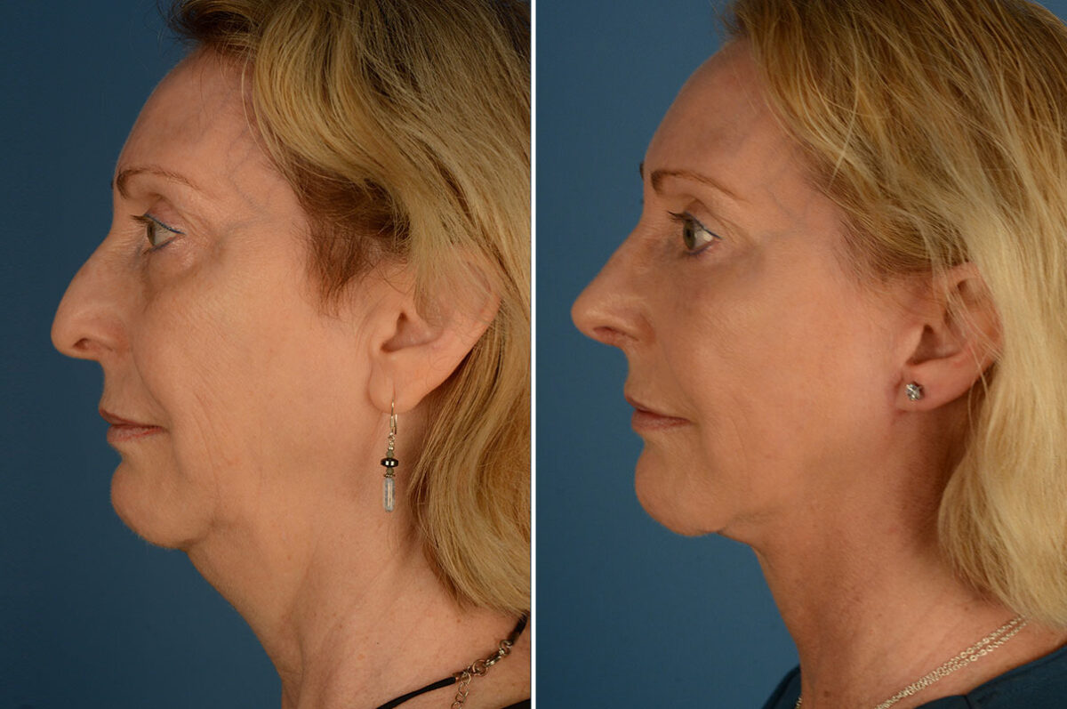 Fat Transfer Before and After Photos in Naples, FL, Patient 23976