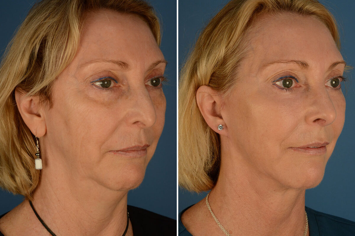 Fat Transfer Before and After Photos in Naples, FL, Patient 23976