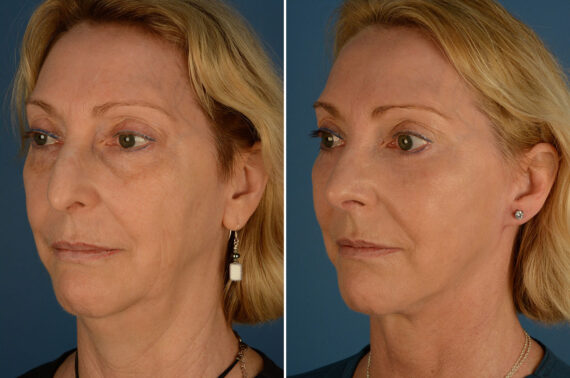 The UpLift™ Lower Face and Neck Lift Before and After Photos in Naples, FL, Patient 23976