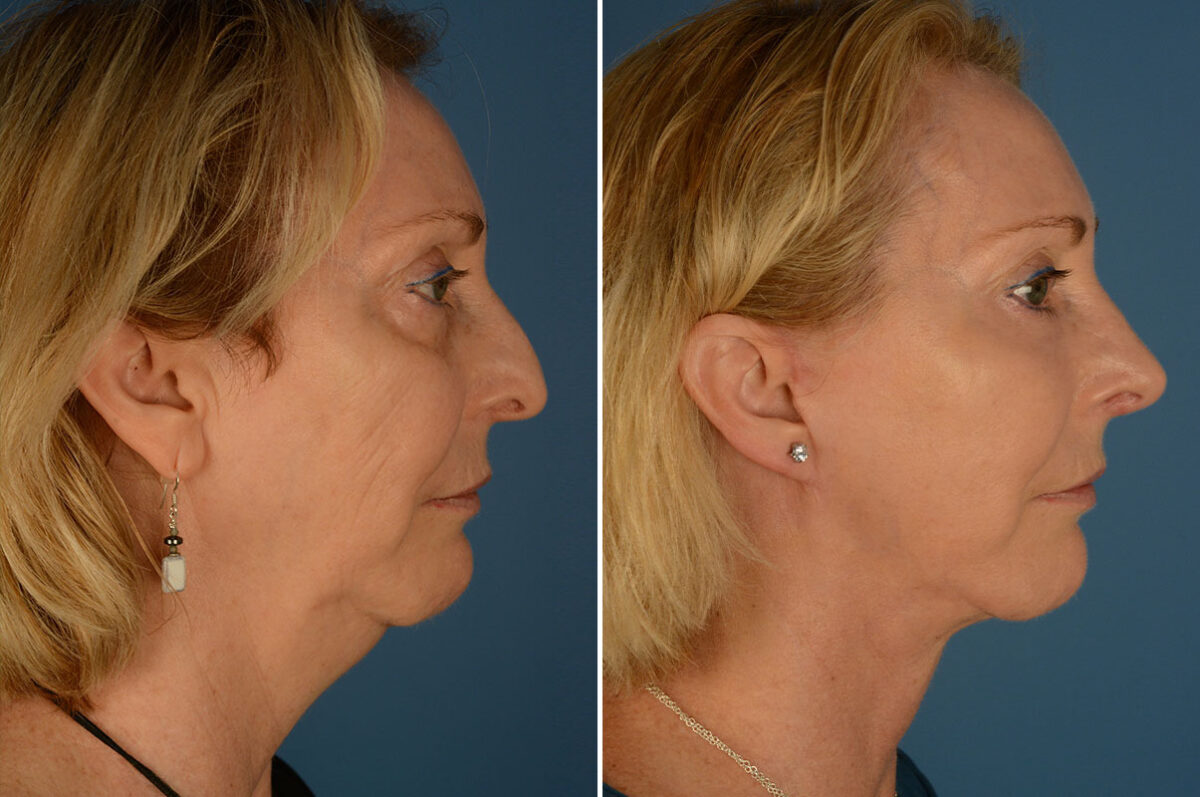 Fat Transfer Before and After Photos in Naples, FL, Patient 23976