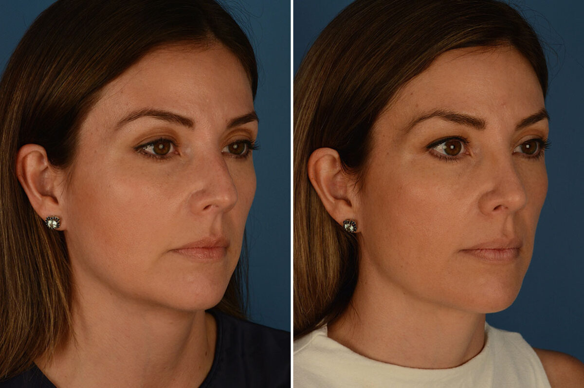 Rhinoplasty Before and After Photos in Naples, FL, Patient 24010