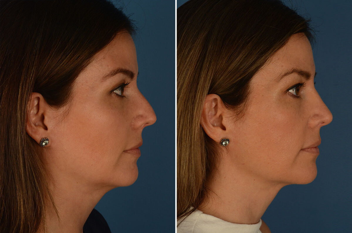 Rhinoplasty Before and After Photos in Naples, FL, Patient 24010