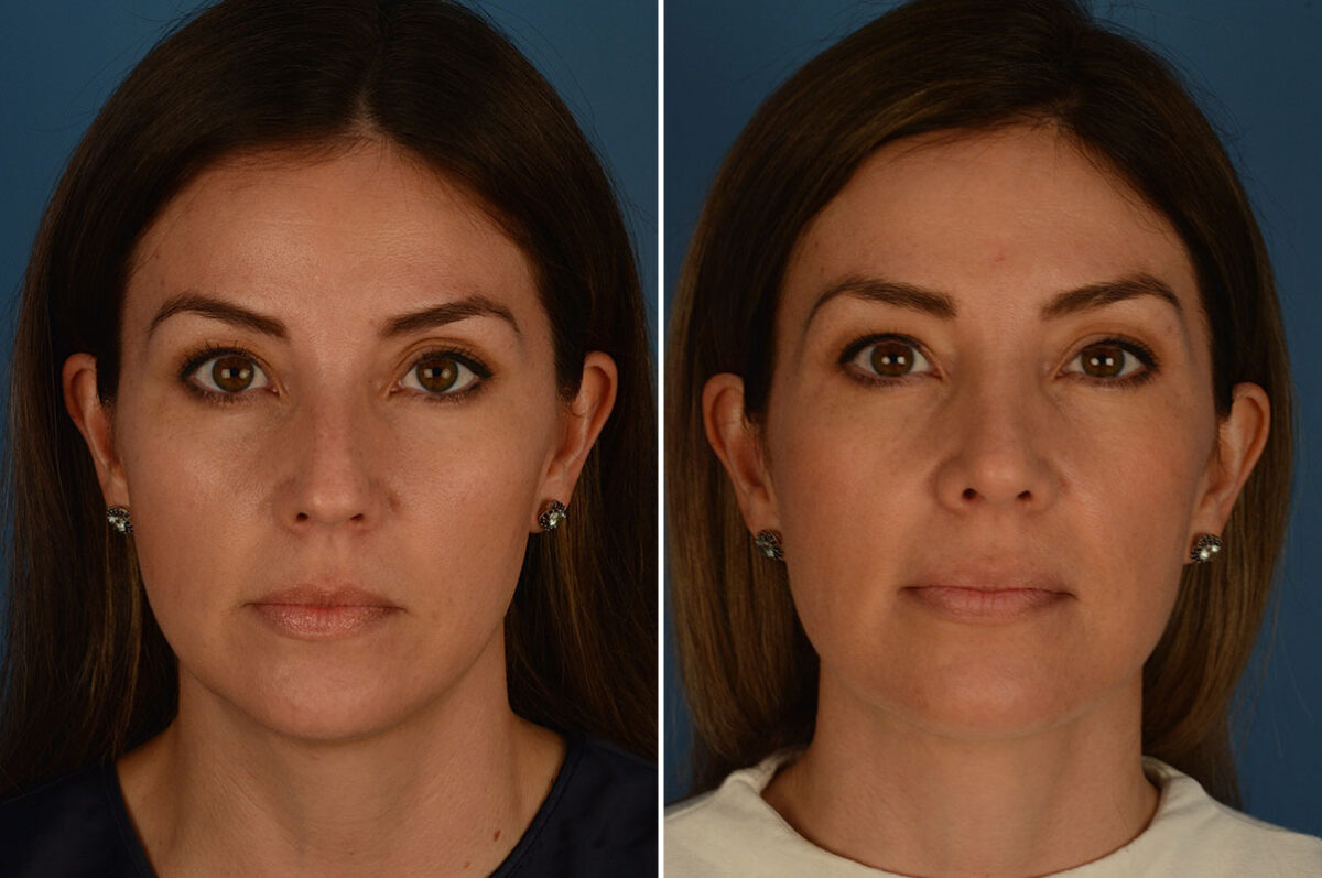 Rhinoplasty Before and After Photos in Naples, FL, Patient 24010