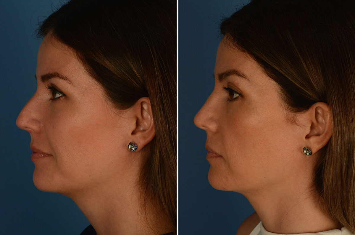 Rhinoplasty Before and After Photos in Naples, FL, Patient 24010