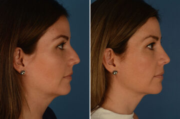 Rhinoplasty Before and After Photos in Naples, FL, Patient 24010