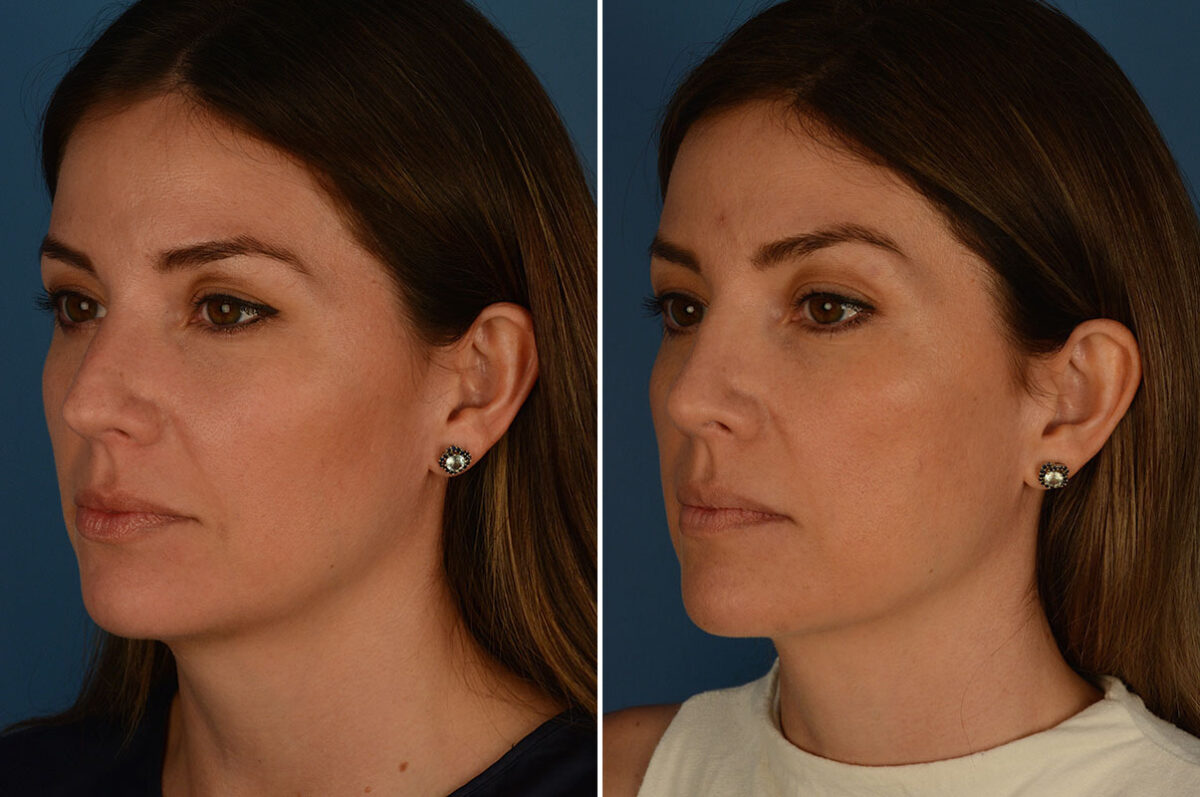 Rhinoplasty Before and After Photos in Naples, FL, Patient 24010