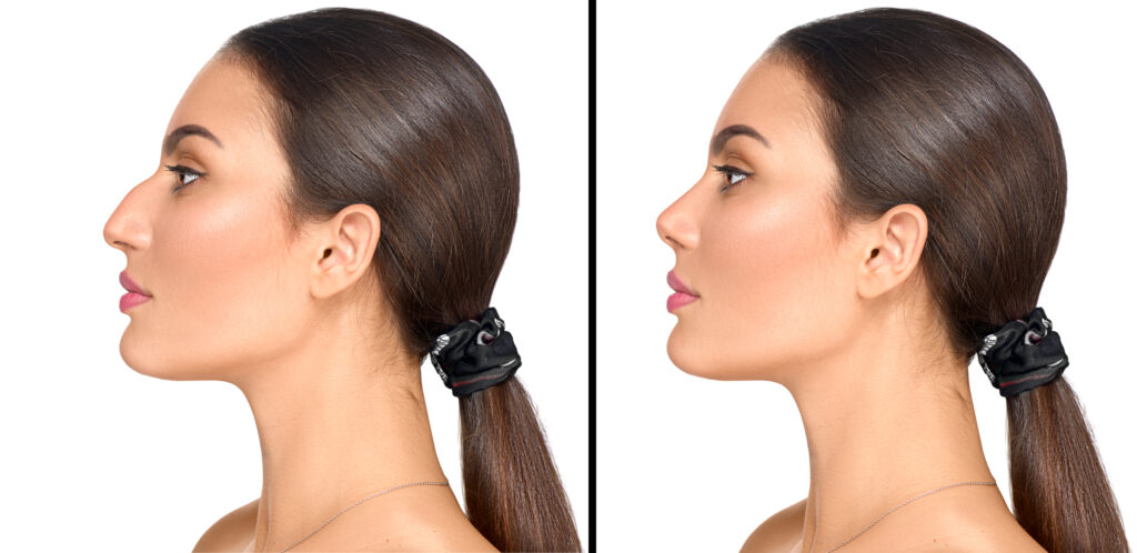 Choose between closed and open rhinoplasty in Naples, FL. 